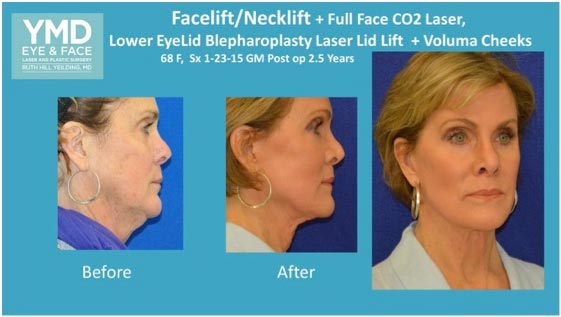 orlando facelift patient before and after photo of 68 year old female