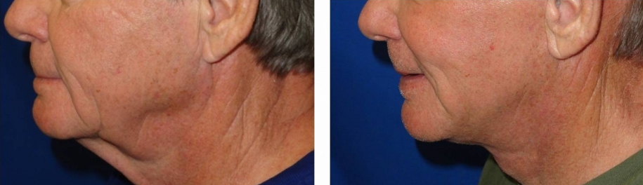 facelift-before-and-after-man-over-45