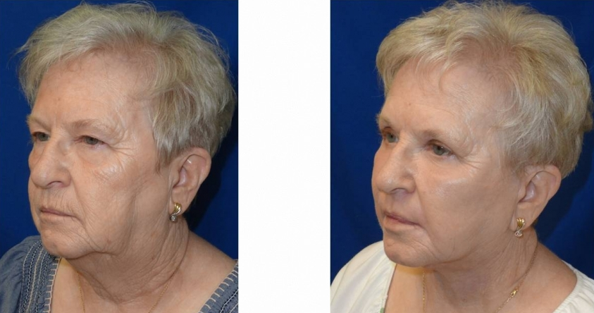 facelift-before-and-after-woman-over-45