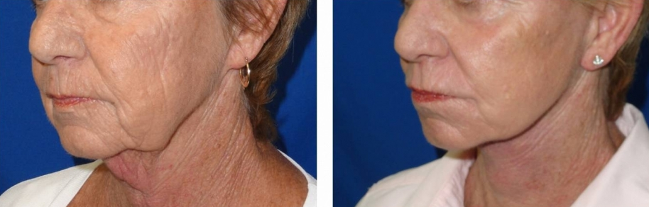 facelift-before-and-after-woman-over-55