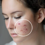 Microneedling for Acne Scars