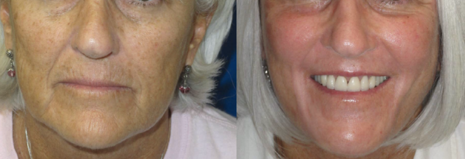 Laser Skin Resurfacing Before and After Photo of Patient 62 Year Old Woman
