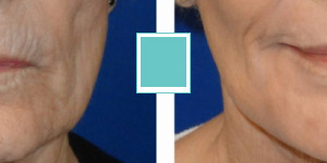 Laser Skin Resurfacing Before and After Photo Gallery Thumbnail