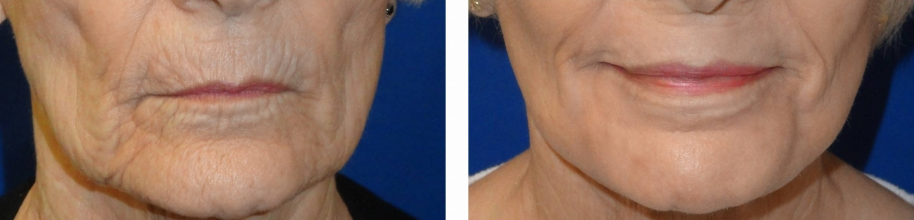 laser-skin-resurfacing-before-and-after-woman-over-40