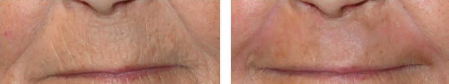 laser-skin-resurfacing-before-and-after-woman-over-45