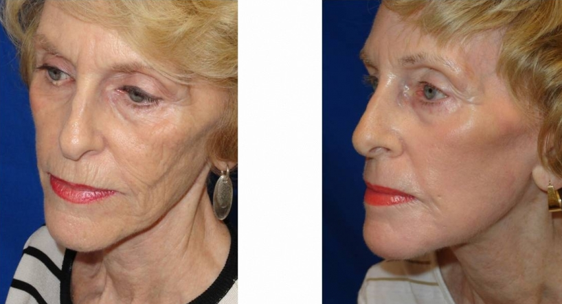 laser-skin-resurfacing-before-and-after-woman-over-50