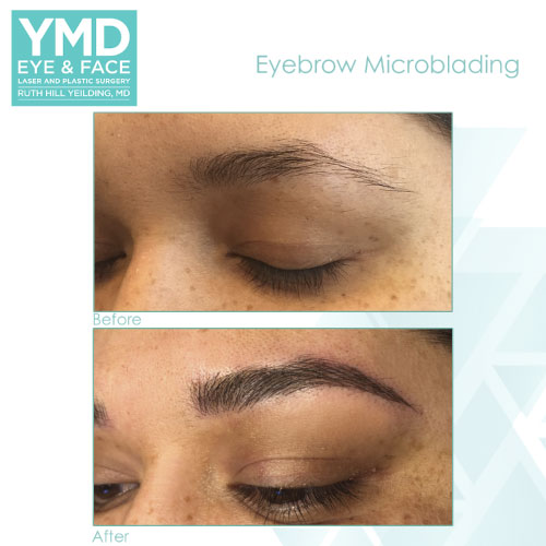 before and after pictures of eyebrow microblading for a woman