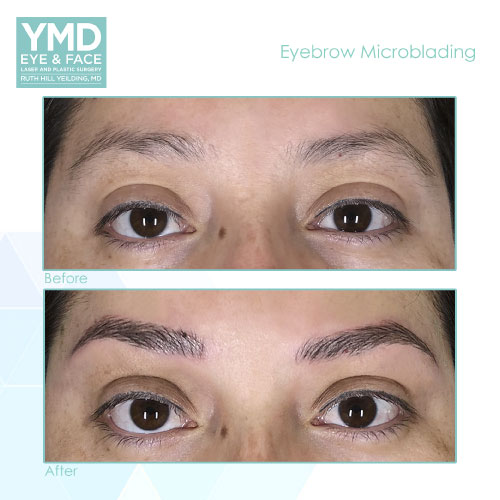 before and after photos of eyebrow microblading for a woman