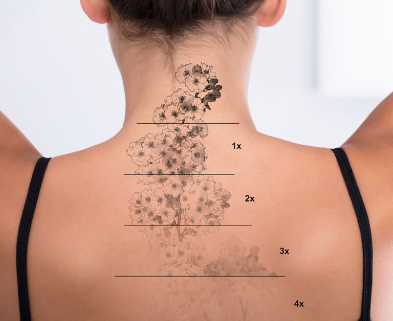 tattoo-removal-orlando Image description