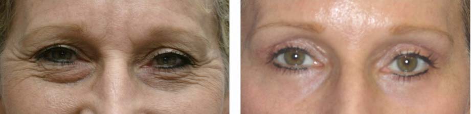 upper-and-lower-blepharoplasty-female-age-54
